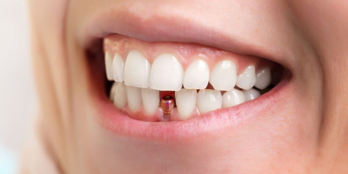 Dentadura de mujer con implantes dentales